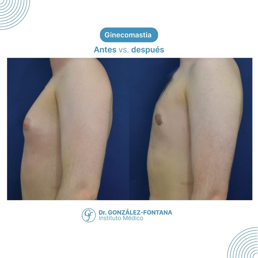 Before and After Result